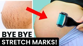 Home Remedies To Prevent Stretch Marks During Pregnancy  Pregnancy Healthy Tips [upl. by Aramas]