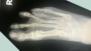 What the Heck Is It  Short Toe Syndrome [upl. by Madel]