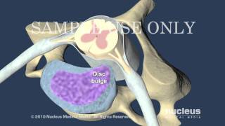 Cervical Disc Herniation [upl. by Ssilb825]