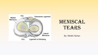 Meniscal tears  classification signs and symptoms MRI findings treatment surgery complications [upl. by Nolly]