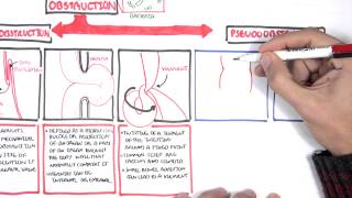 Bowel Obstruction  Causes and Pathophysiology [upl. by Rouvin]