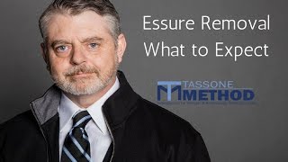 Essure Removal  What To Expect [upl. by Ydnec]