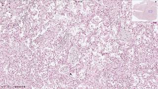 Pneumocystis Jirovecii Pneumonia  Histopathology [upl. by Radnaskela130]