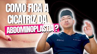 COMO FICA A CICATRIZ DA ABDOMINOPLASTIA CIRURGIA PLÁSTICA [upl. by Hulda955]