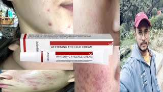 zoo son whitening freckle cream  honest review [upl. by Bondy]