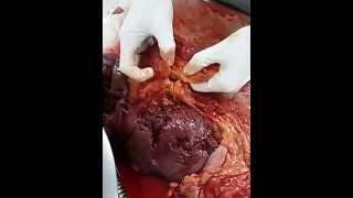 Perforated duodenal ulcer [upl. by Drusi523]