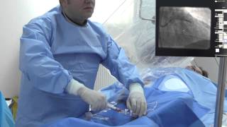 ARES  Angioplastie coronariana cu stent bioresorbabil Absorb  Dr Roberto Haret [upl. by Mann740]