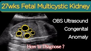 27wks Fetal Multicystic Kidney  OBS Ultrasound Congenital Anomalies [upl. by Mcclenon503]