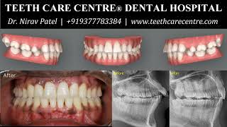 Invisalign Before and After  Premolar Extraction Case [upl. by Inohtna]