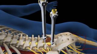 Lumbar Fusion of L5 S1 Animation [upl. by Hamlani]