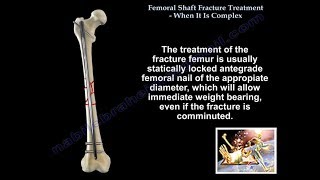 Femoral Shaft Fracture When It Is Complex  Everything You Need To Know  Dr Nabil Ebraheim [upl. by Emiatej969]