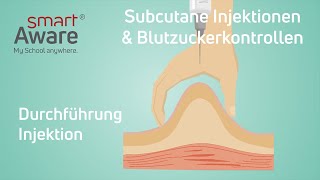 Subcutane Injektionen und Blutzuckermessung Durchführung einer Injektion  Fachfortbildungen Pflege [upl. by Alton]