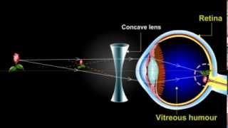 what is myopia Short Sightedness [upl. by Notnyw]