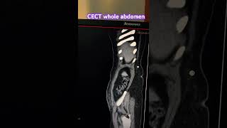 CECT whole abdomen Hernia problems trending anatomy ctscan abdoabdoherniation contrast [upl. by Memberg636]