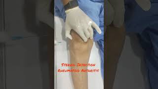 Steroid Injection in Knee Joint  Rheumatoid Arthritis  Dr Prateek Joshi घुटनें में स्टिरॉइड [upl. by Rutger]