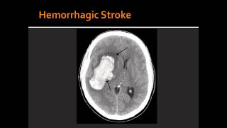 Atherosclerosis Hemorrhagic Stroke Ischemic Stroke amp Transient Ischemic Attack TIA [upl. by Navonod51]