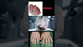 Chilblains Swelling in hands and feet [upl. by Denby]