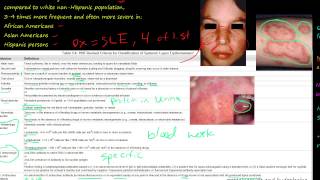 89P Systemic lupus erythematosus SLE how to diagnosis Etiology and Pathogenesis [upl. by Akerdnuhs219]