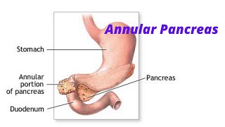 Annular Pancreas fmge neetpg usmle [upl. by Ecnirp]