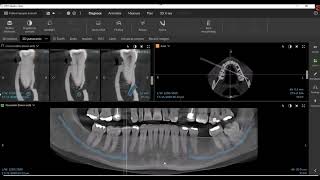 DTX Studio™ Clinic Featuring MagicAssist Nerve Mapping [upl. by Cherey]