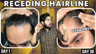 सिर्फ 1 महीने मैं RECEDING HAIRLINE REGROW करो  30 days HAIRLINE REGROWTH challenge [upl. by Adnek]