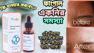 Melao Salicylic acid review  এই একটি সিরামে আপনার স্কিনের ব্রন দূর করবে😱 [upl. by Jenkins]