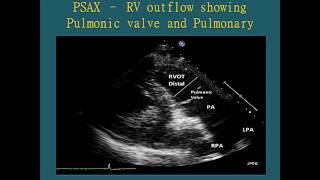 Normal Views  Transthoracic Echocardiogram TTE [upl. by Asillem]