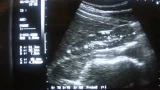 RT SMALL and LT NORMAL KIDNEY [upl. by Milli]