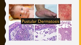 6 Pustular Dermatosis [upl. by Imorej412]