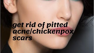 Getting Rid of Pitted AcneChickenpox Scars Subliminal  Glazed Subliminals [upl. by Naves983]