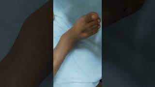 Pitting edema  DCLD patient clinicalexamination hospital doctor [upl. by Rice]