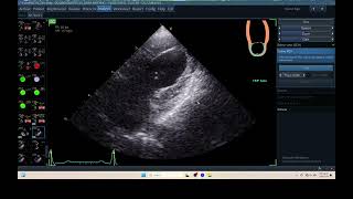 IQ 306 AFI LA ECHOPAC ANALYSIS HEPATOMA PTE ECHOCARDIOGRAPHY [upl. by Pillihp]