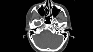 Fibrous Dysplasia Clivus [upl. by Noet990]