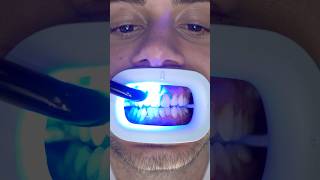 Transformation of Yellow Teeth teethwhitening [upl. by Nolana491]