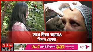 বোটক্স তারুণ্য ধরে রাখতে গিয়ে এখন মুখ দেখানোই দায়  Botox Injections  Botulinum Toxin  Somoy TV [upl. by Yma]