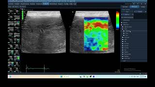 IQ 281 HEPATOMA ECHOPAC ANALYSIS ULTRASOUND ELASTOGRAPHY [upl. by Atilamrac]