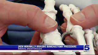 Medical Breakthrough New minimallyinvasive bunionectomy procedure [upl. by Liuka]