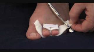 Tips For Buying A Toe Digit Wrap  MYFOOTSHOPCOM [upl. by Iggam]