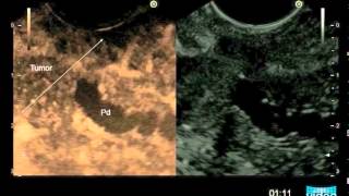 Endoscopic Ultrasound in Acute Pancreatitis [upl. by Akli]