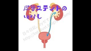 尿管ステントを抜くときの痛みはどれくらい？【抜去時の痛み】 [upl. by Barthol330]