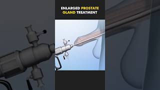 Enlarge prostate gland youtubeshorts 3danimation viralshorts [upl. by Yesac108]