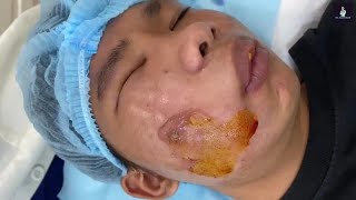 Severe Infection on Cheek Drained [upl. by Hafeenah]