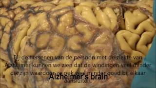 Dissectie hersenen normaal en Alzheimer [upl. by Anaira]