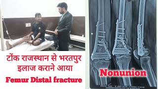 Nonunion Femur distal fracture plate band Re surgery after 5 months [upl. by Ihskaneem]