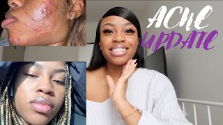 SKINCARE SATURDAYS  HOW I CLEARED 6 YEARS OF ACNE IN 3 MONTHS  FT MDacne [upl. by Ennasil76]