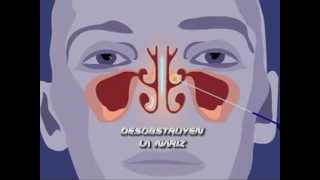 CIRUGIA LASER MULTILEVEL EN RONQUIDO Y APNEAS DEL SUEÑO [upl. by Howland]