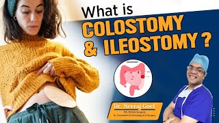 What is colostomy amp ileostomy  Stoma Bag Kya hai Dr Neeraj Goel [upl. by Schulein]