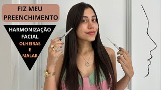 FIZ MEU PREENCHIMENTO SOZINHA  OLHEIRAS E MALAR  HARMONIZAÇÃO FACIAL [upl. by Wickner100]