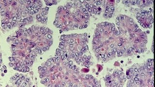 Thyroid Neoplasms  Pathology mini tutorial [upl. by Alaikim305]