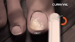 Top 5 Remedies To Cure Nail Fungus Just In 7 Days At Home  Pharmacist Javaid [upl. by Aicatsana286]